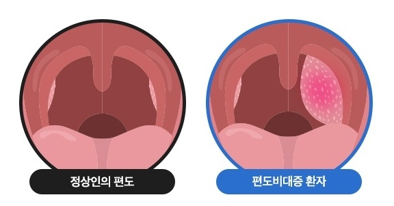 편도비대의 원인
