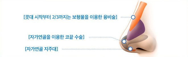 콧대 시작부터 2/3까지는 보형물을 이용한 융비술