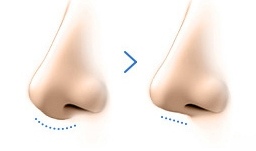 콧기둥 교정술